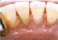Dentln hygiena - po odstrann zubnho kamene
