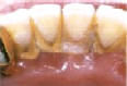Dentln hygiena - odstrann zubnho kamene