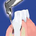 Oeten dsn a sliznic laserem (parodontologie)