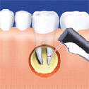 Stomatochirurgie s vyuitm zubnho laseru
