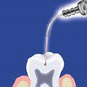 Oeten zubnch kaz laserem (zchovn stomatologie)