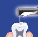 Oeten zubnch kaz laserem (zchovn stomatologie)